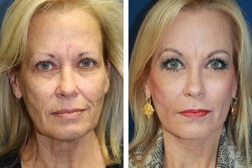 Before and after photos of a woman's face, front view, for facelift