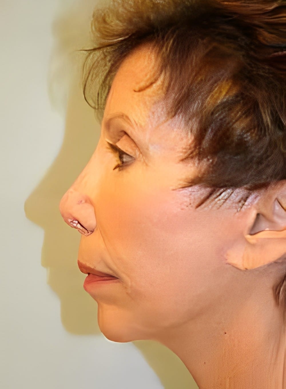 After Image: Fat Grafting Cheeks-Dr. Kenrick Spence - left-side