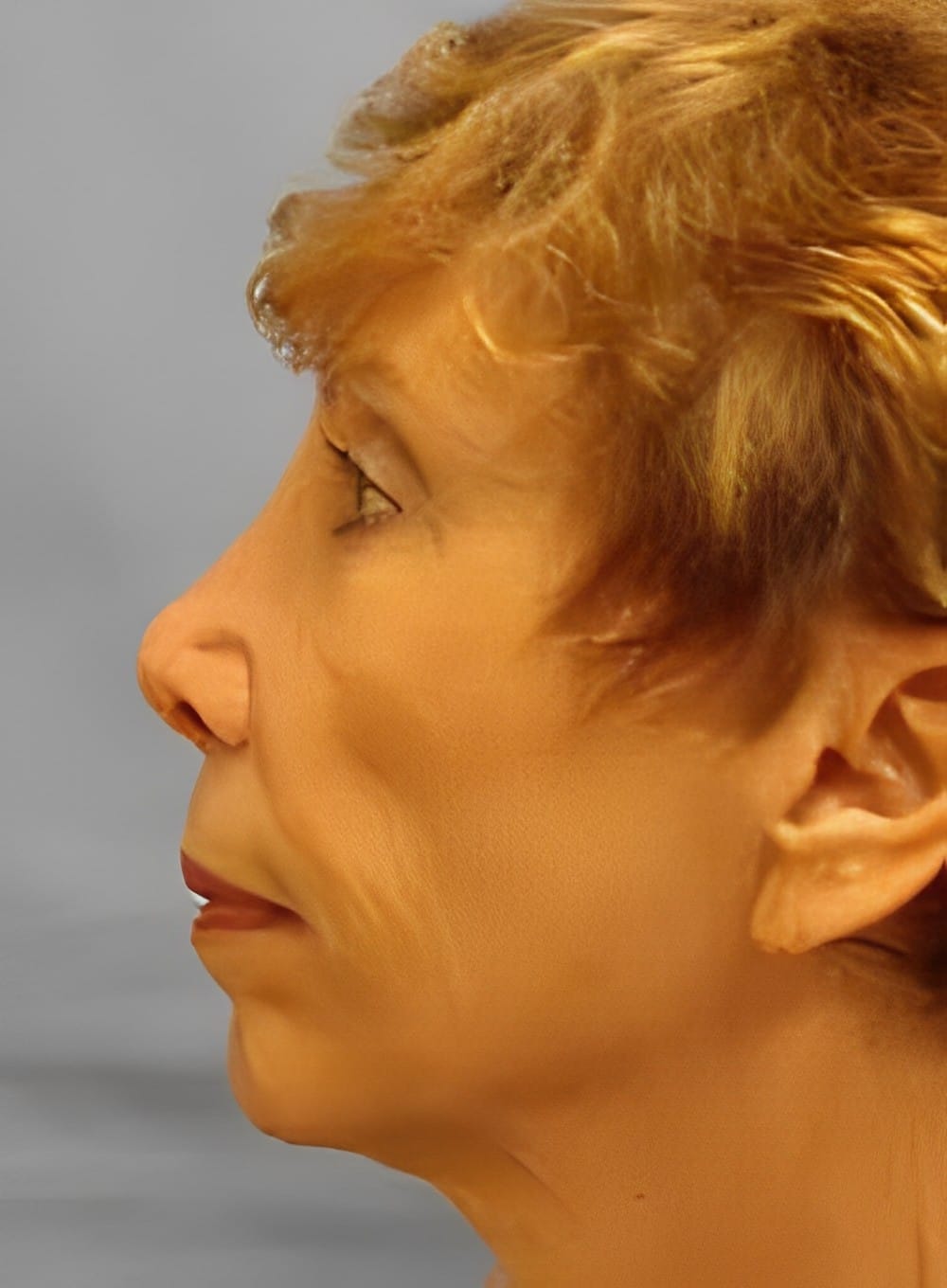 Before Image: Fat Grafting Cheeks-Dr. Kenrick Spence - left-side