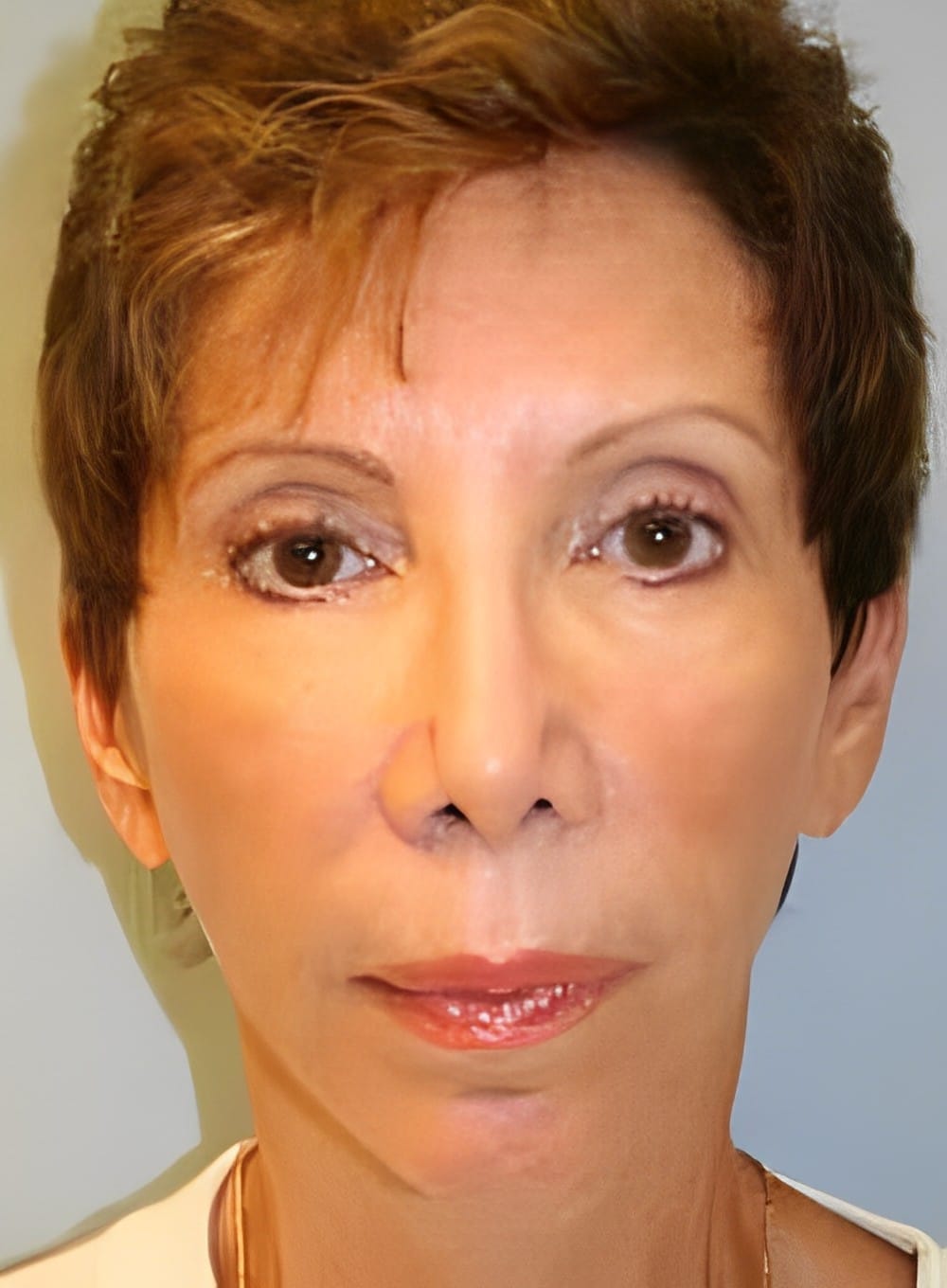 After Image: Fat Grafting Cheeks-Dr. Kenrick Spence - front