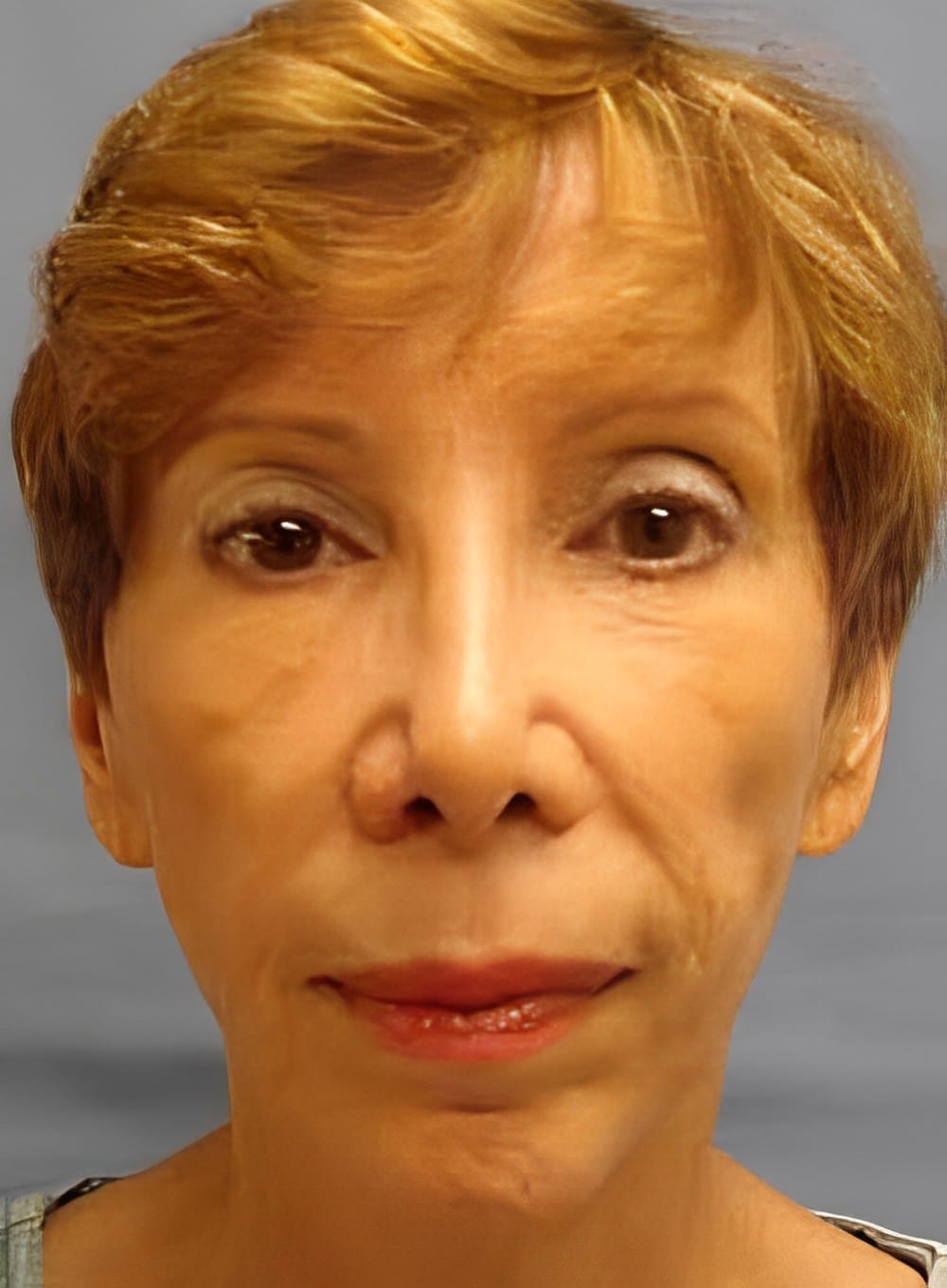 Before Image: Fat Grafting Cheeks-Dr. Kenrick Spence - front