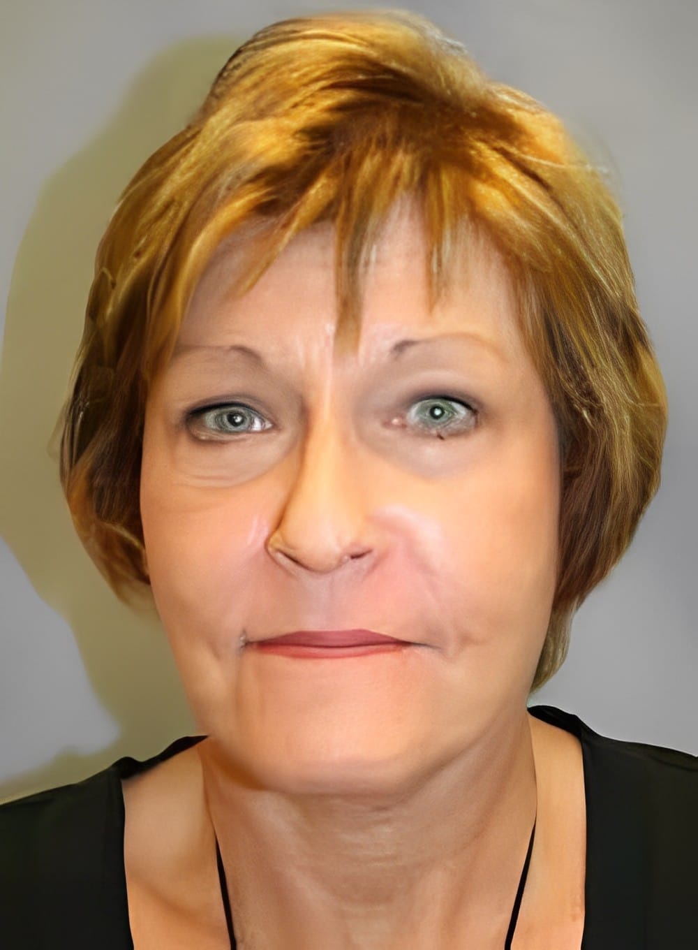 After Image: Fat Grafting Cheeks-Dr. Kenrick Spence - front