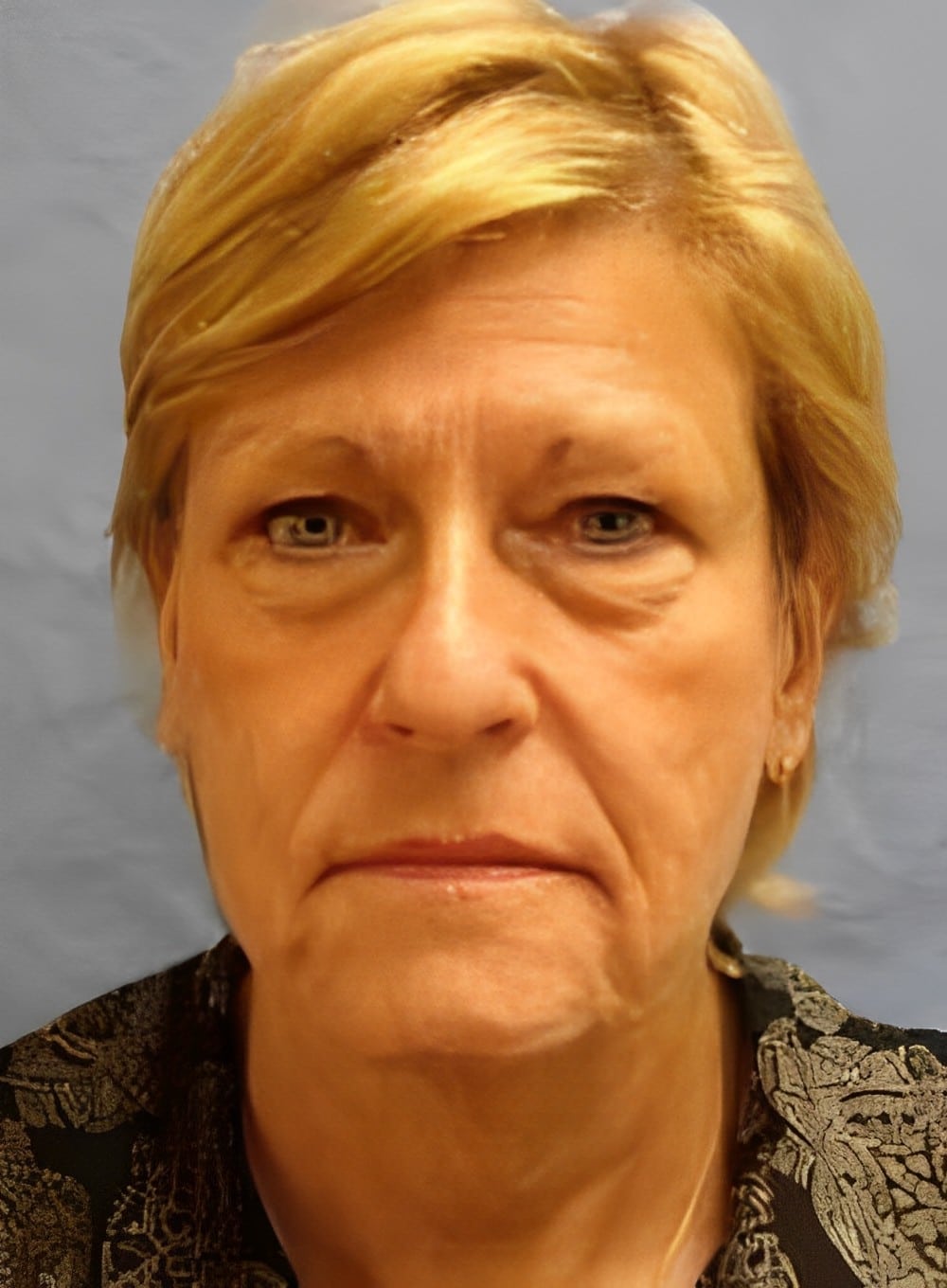Before Image: Fat Grafting Cheeks-Dr. Kenrick Spence - front