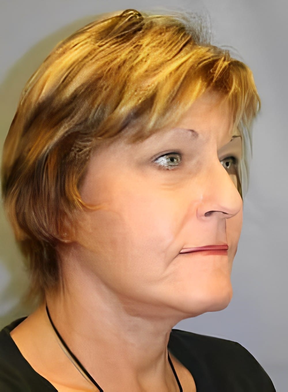 After Image: Fat Grafting Cheeks-Dr. Kenrick Spence - right-front-oblique