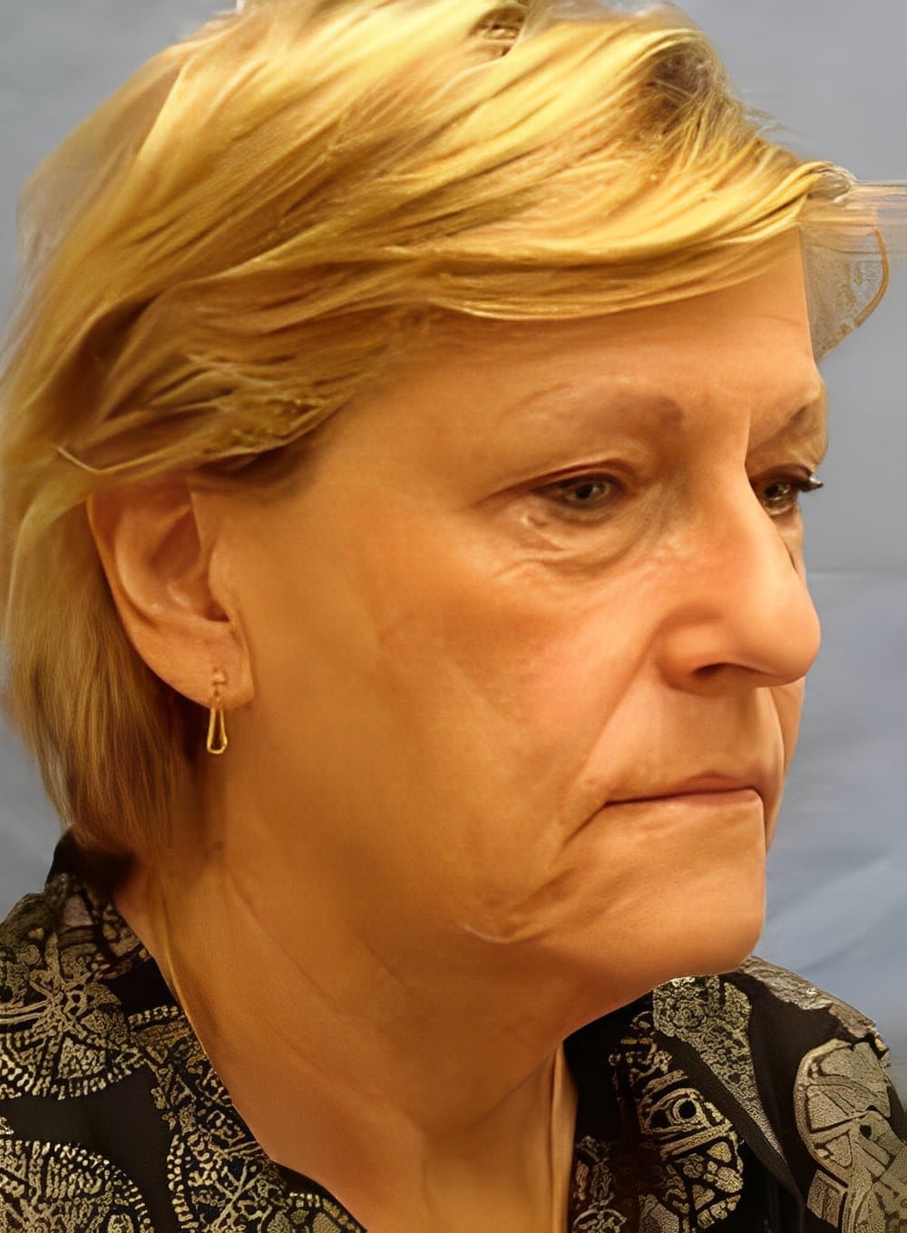 Before Image: Fat Grafting Cheeks-Dr. Kenrick Spence - right-front-oblique
