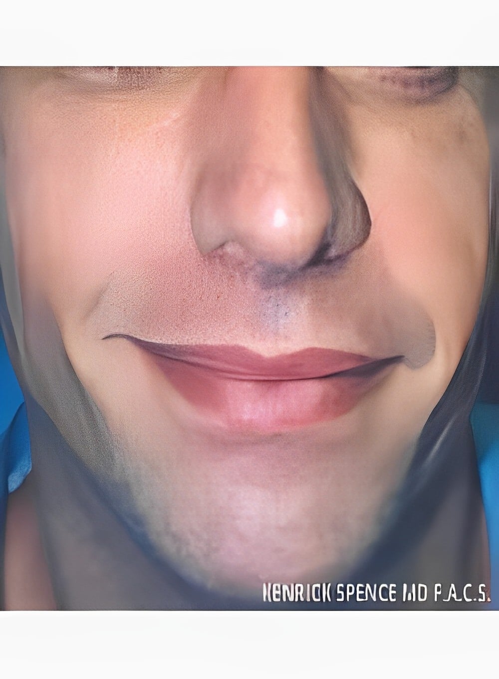 After Image: Fat Grafting Cheeks-Dr. Kenrick Spence - front