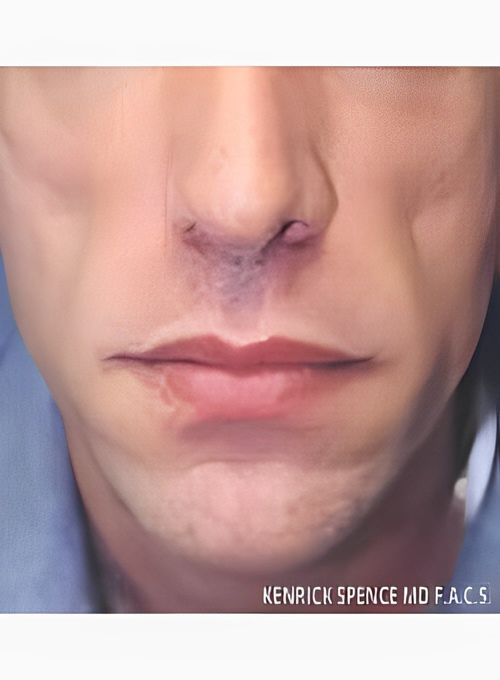 Before Image: Fat Grafting Cheeks-Dr. Kenrick Spence - front