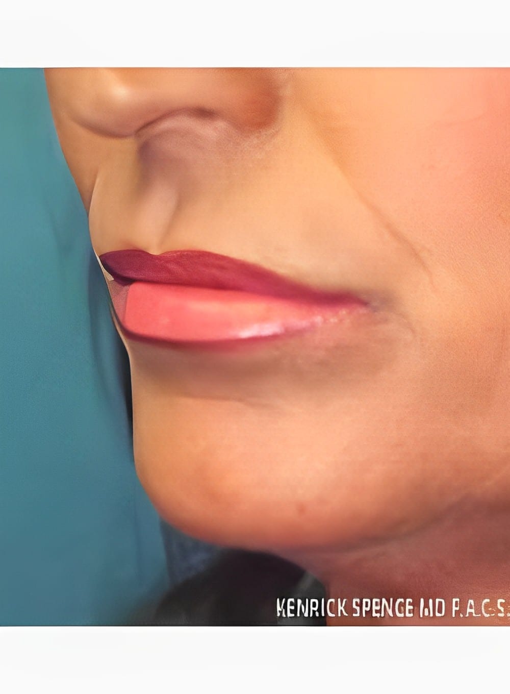 After Image: Fat Grafting Lips-Dr. Kenrick Spence - left-front-oblique