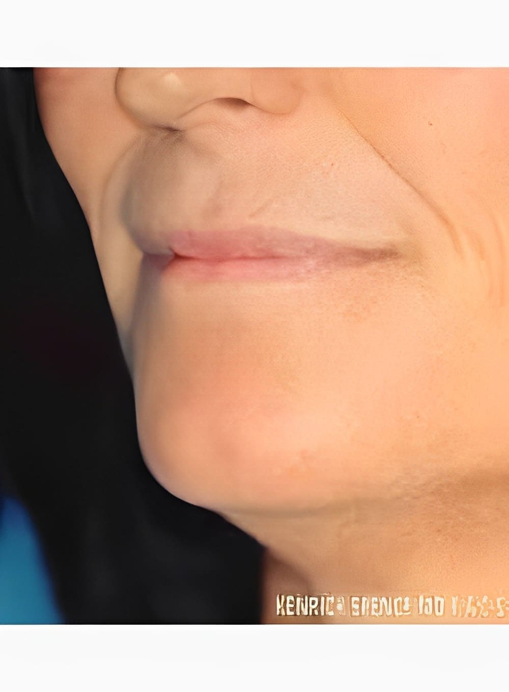 Before Image: Fat Grafting Lips-Dr. Kenrick Spence - left-front-oblique