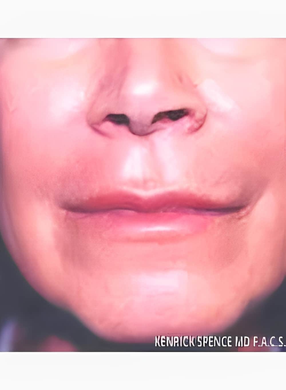 After Image: Fat Grafting Lips-Dr. Kenrick Spence - other
