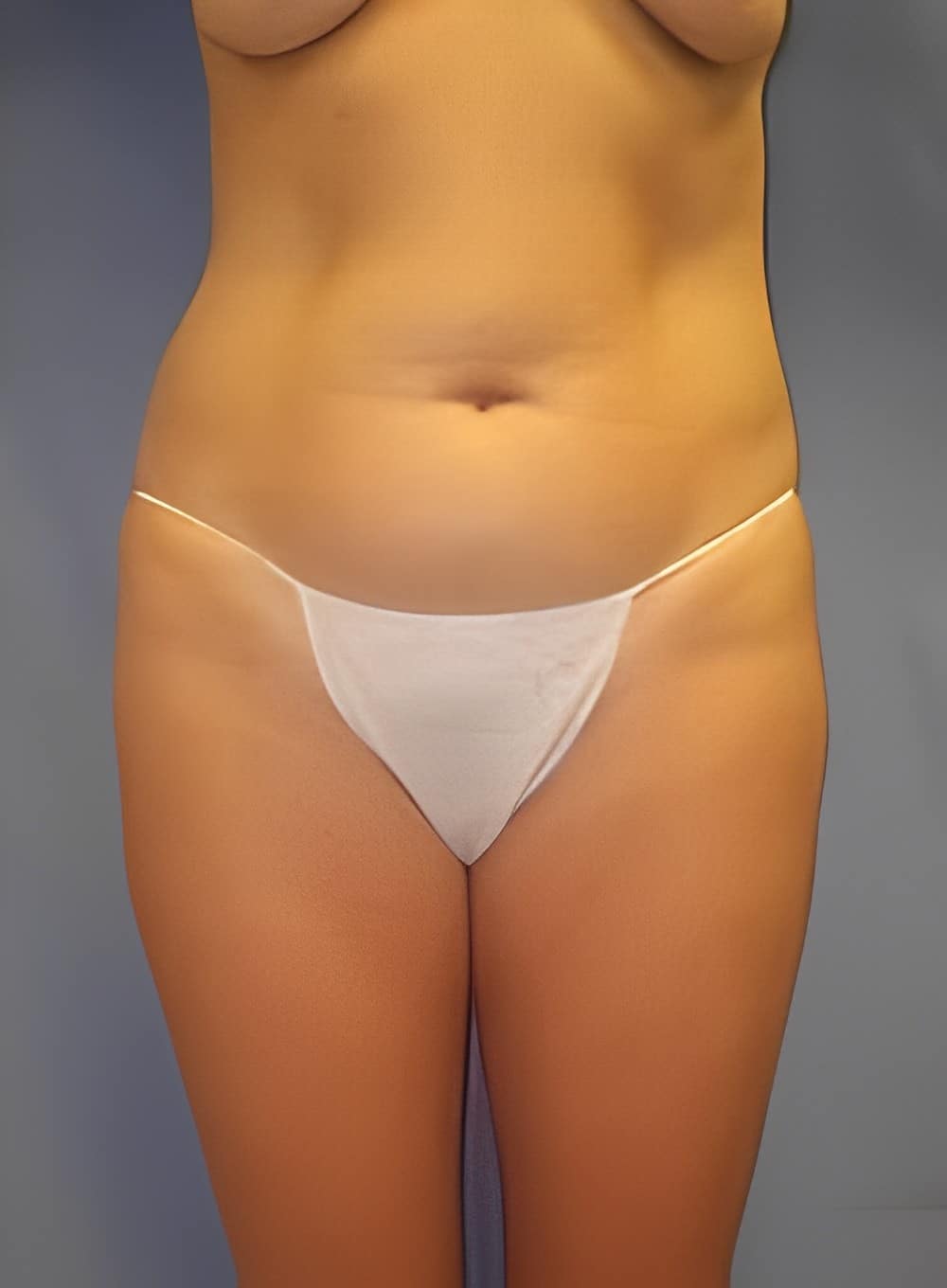 Before Image: Liposuction Abdomen-Dr. Kenrick Spence - front