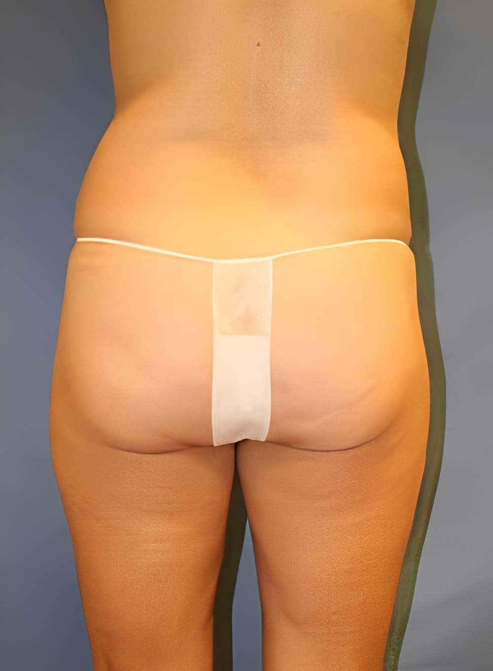 Before Image: Liposuction Abdomen-Dr. Kenrick Spence - back
