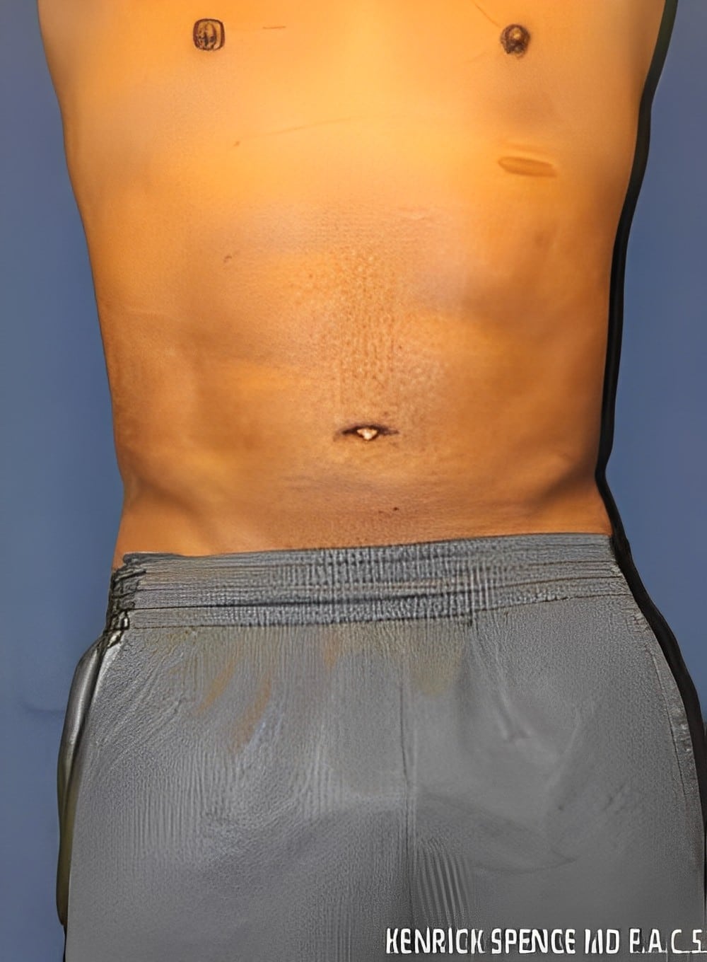 After Image: Liposuction Abdomen-Dr. Kenrick Spence - front