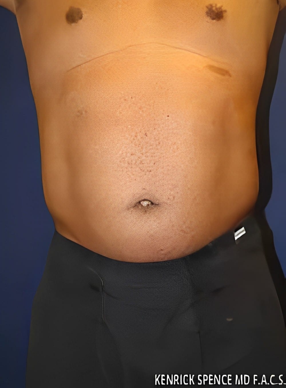 Before Image: Liposuction Abdomen-Dr. Kenrick Spence - front