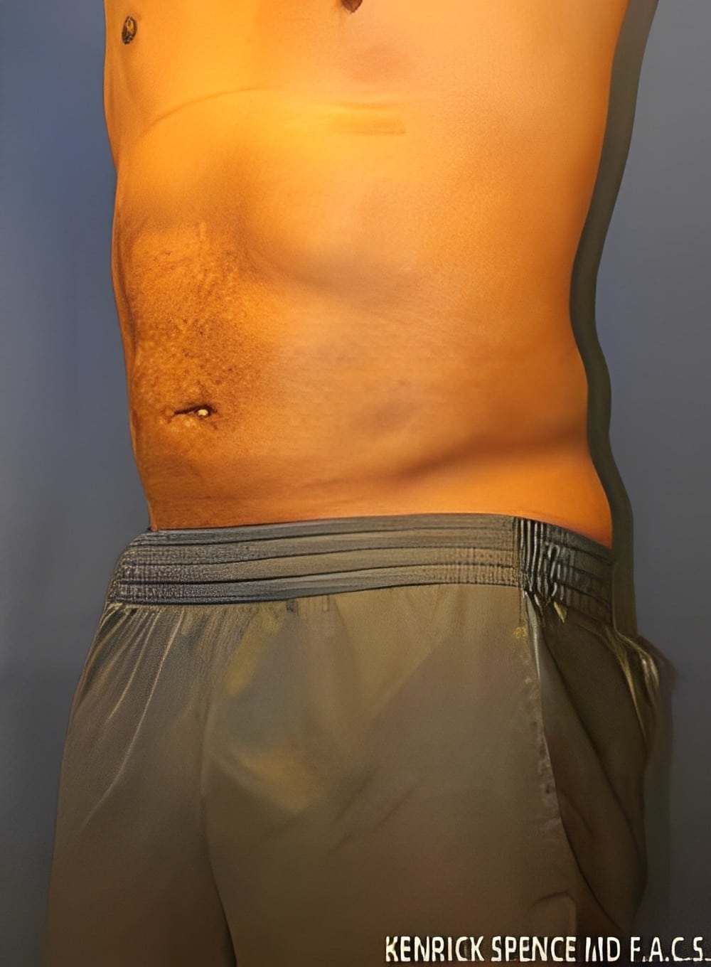 After Image: Liposuction Abdomen-Dr. Kenrick Spence - left-front-oblique