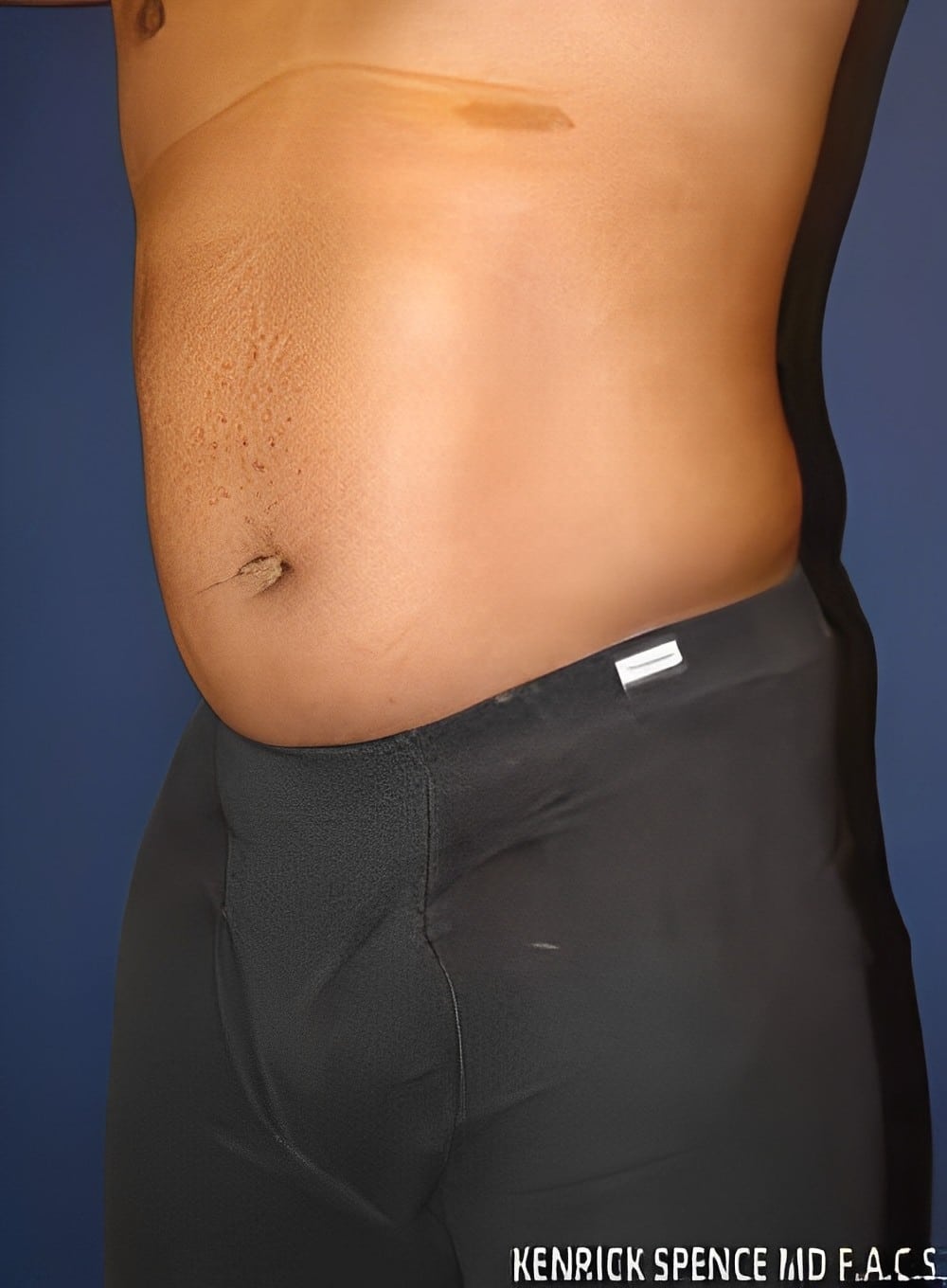 Before Image: Liposuction Abdomen-Dr. Kenrick Spence - left-front-oblique