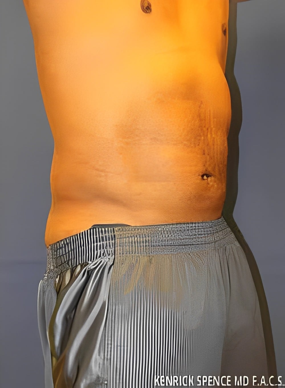 After Image: Liposuction Abdomen-Dr. Kenrick Spence - right-front-oblique