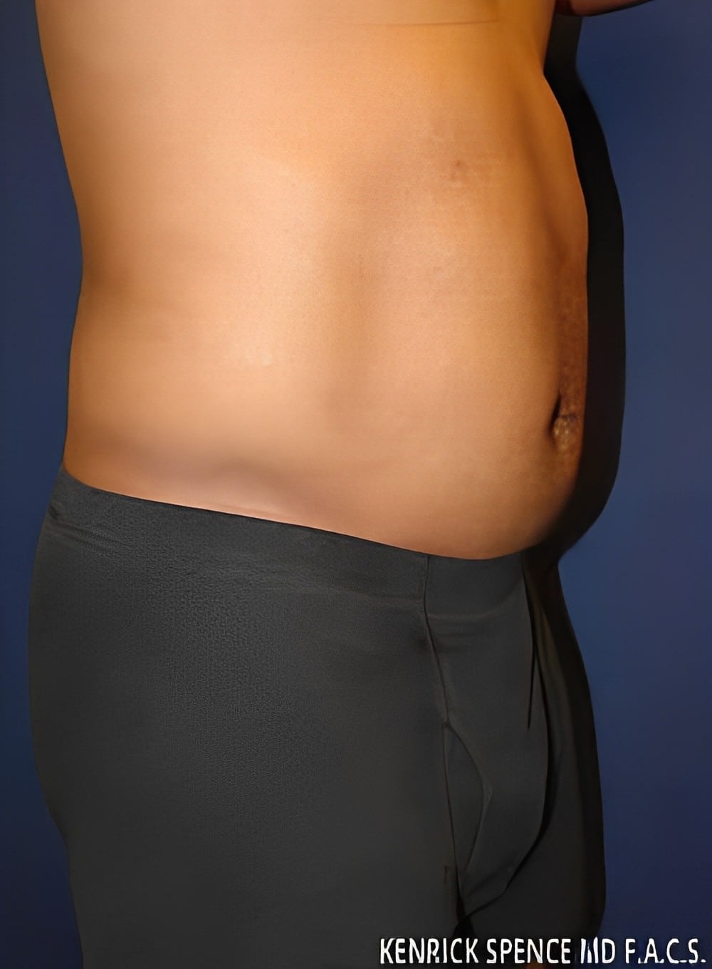 Before Image: Liposuction Abdomen-Dr. Kenrick Spence - right-front-oblique