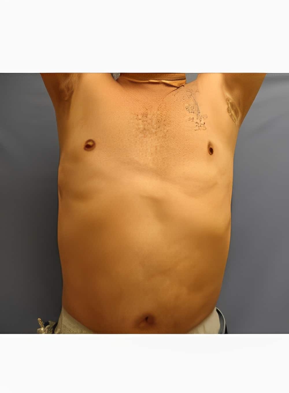 After Image: Liposuction Abdomen-Dr. Kenrick Spence - front
