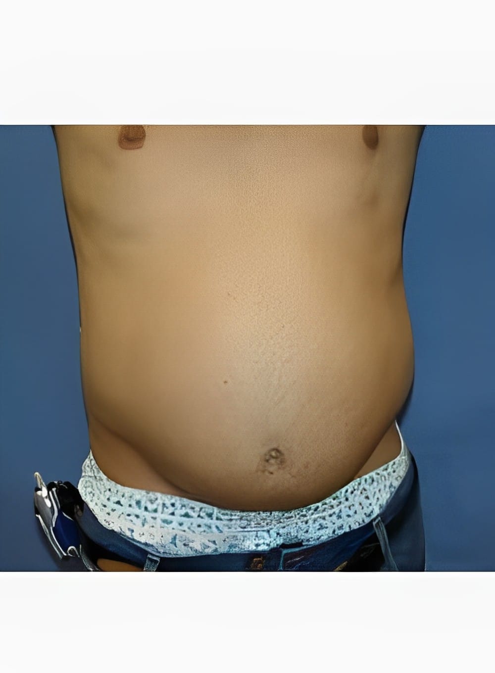 Before Image: Liposuction Abdomen-Dr. Kenrick Spence - front