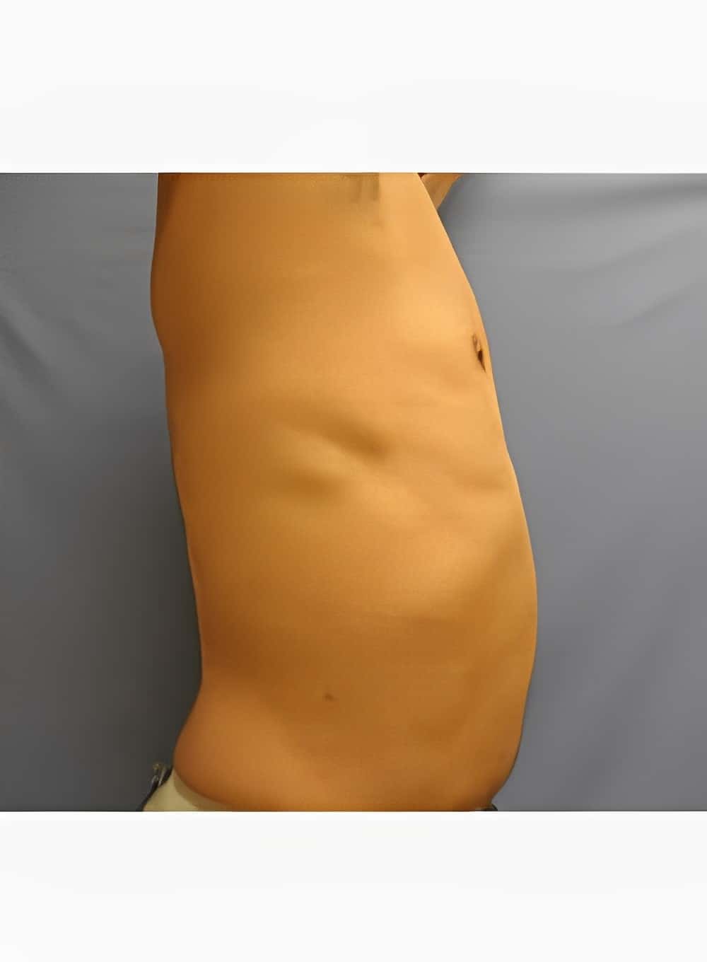 After Image: Liposuction Abdomen-Dr. Kenrick Spence - right-side