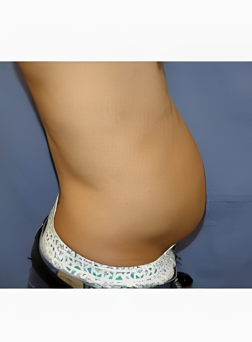 Before Image: Liposuction Abdomen-Dr. Kenrick Spence - right-side