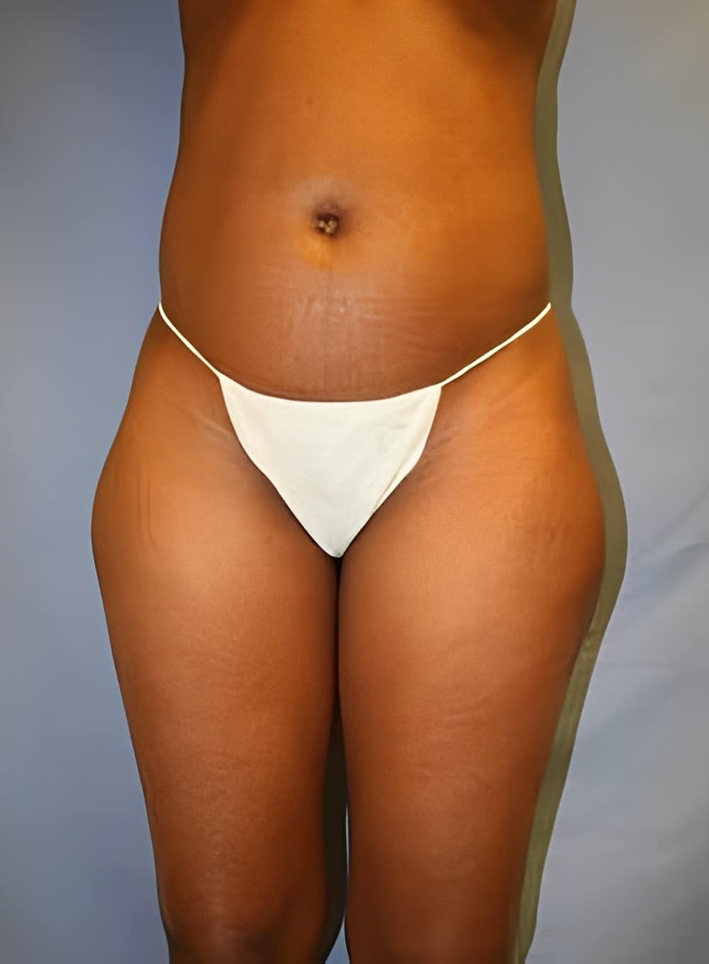 Before Image: Liposuction Abdomen-Dr. Kenrick Spence - front