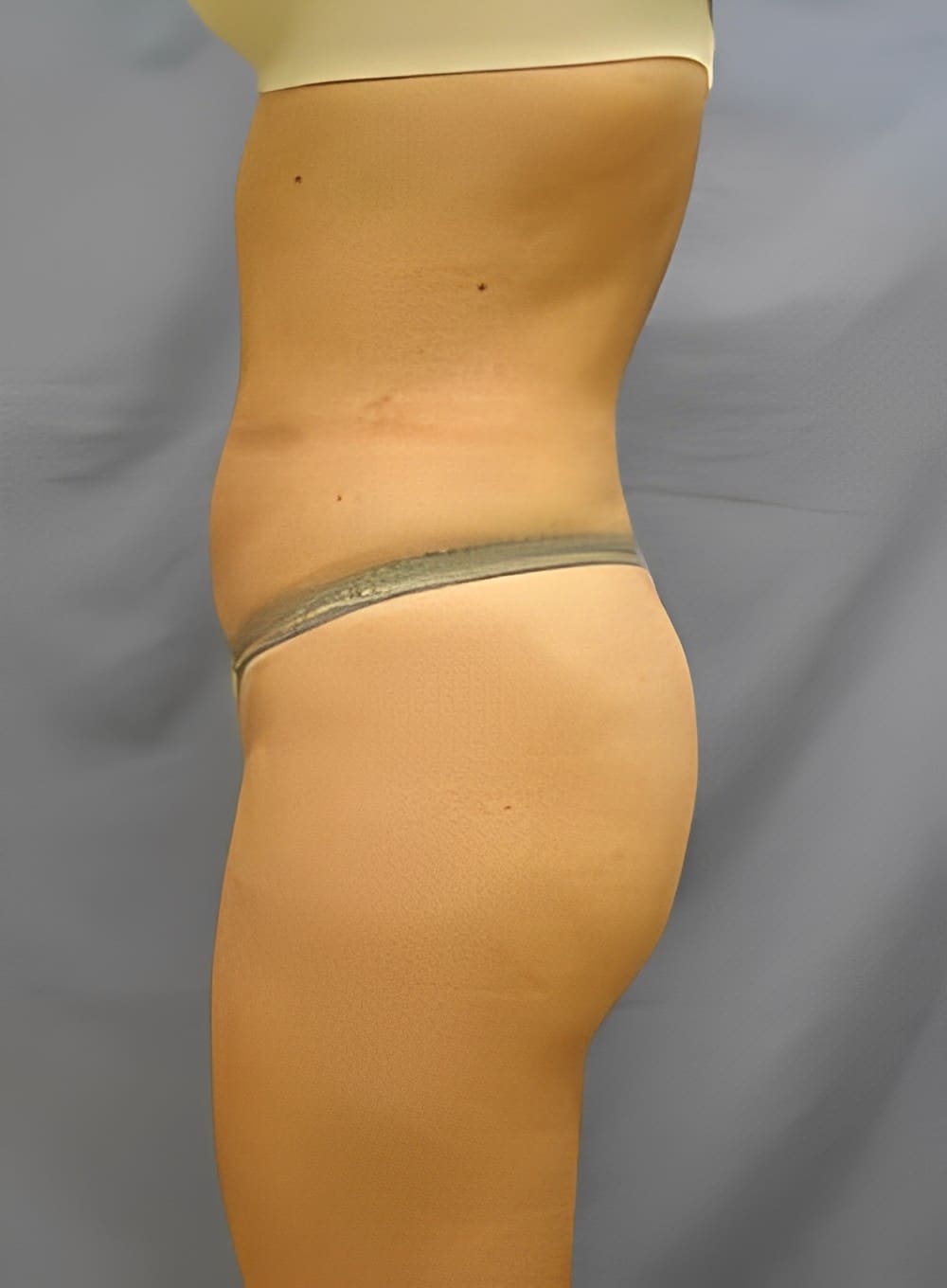 After Image: Liposuction Abdomen-Dr. Kenrick Spence - left-side