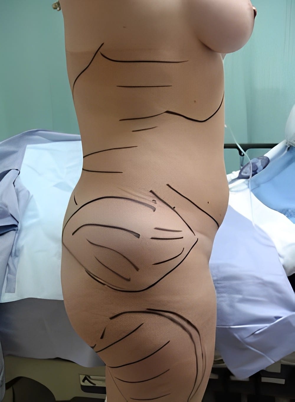 Before Image: Liposuction Abdomen-Dr. Kenrick Spence - right-side