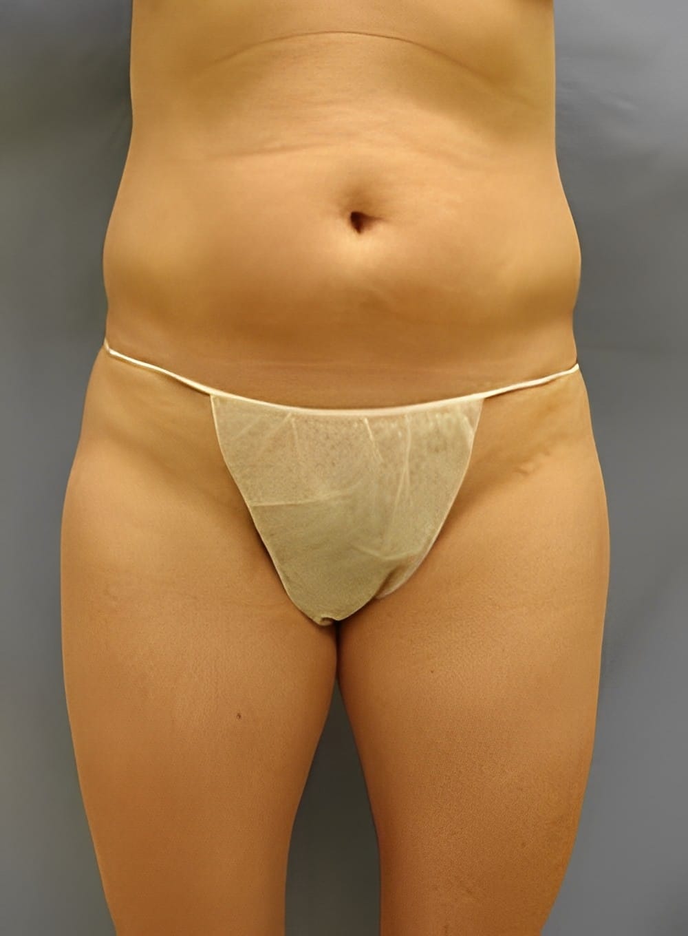 Before Image: Liposuction Abdomen-Dr. Kenrick Spence - front
