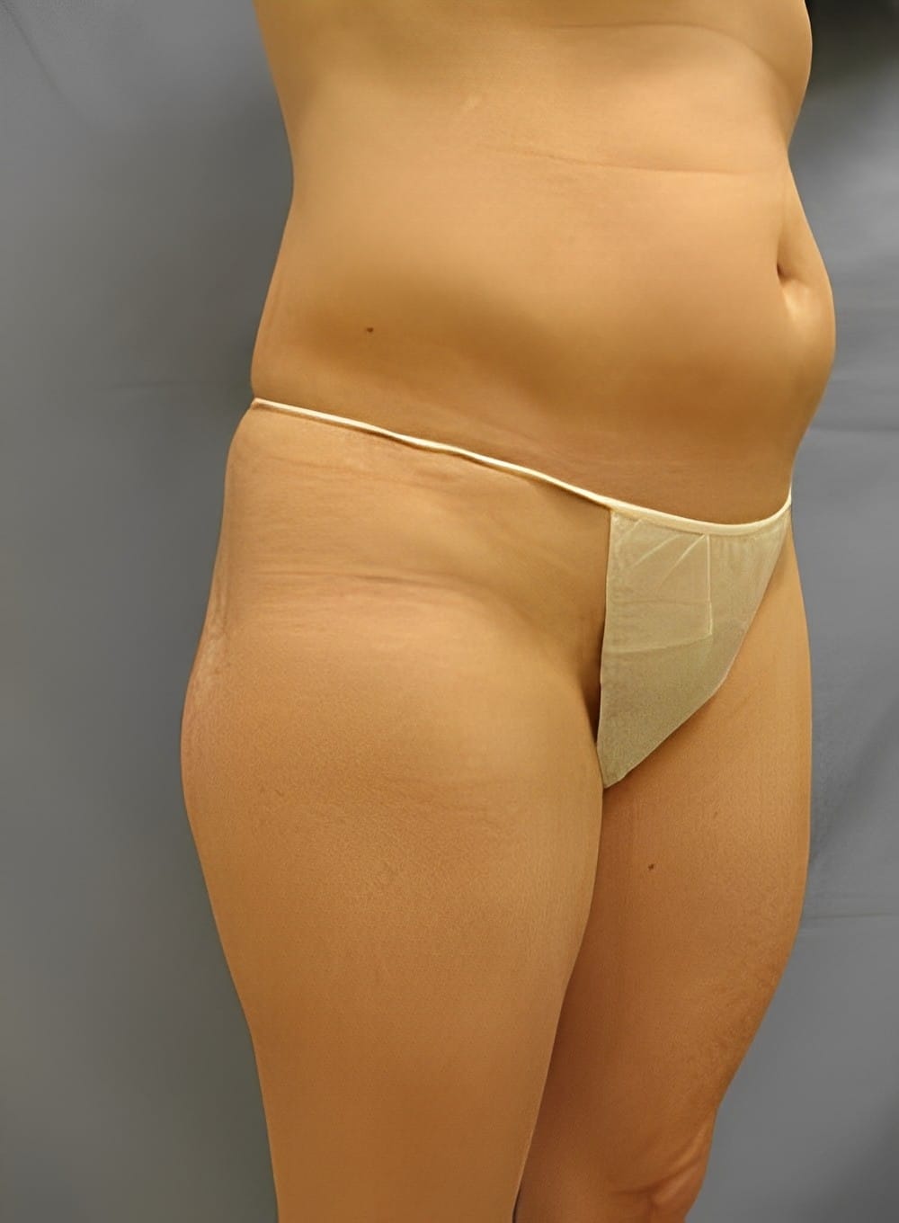 Before Image: Liposuction Abdomen-Dr. Kenrick Spence - right-front-oblique
