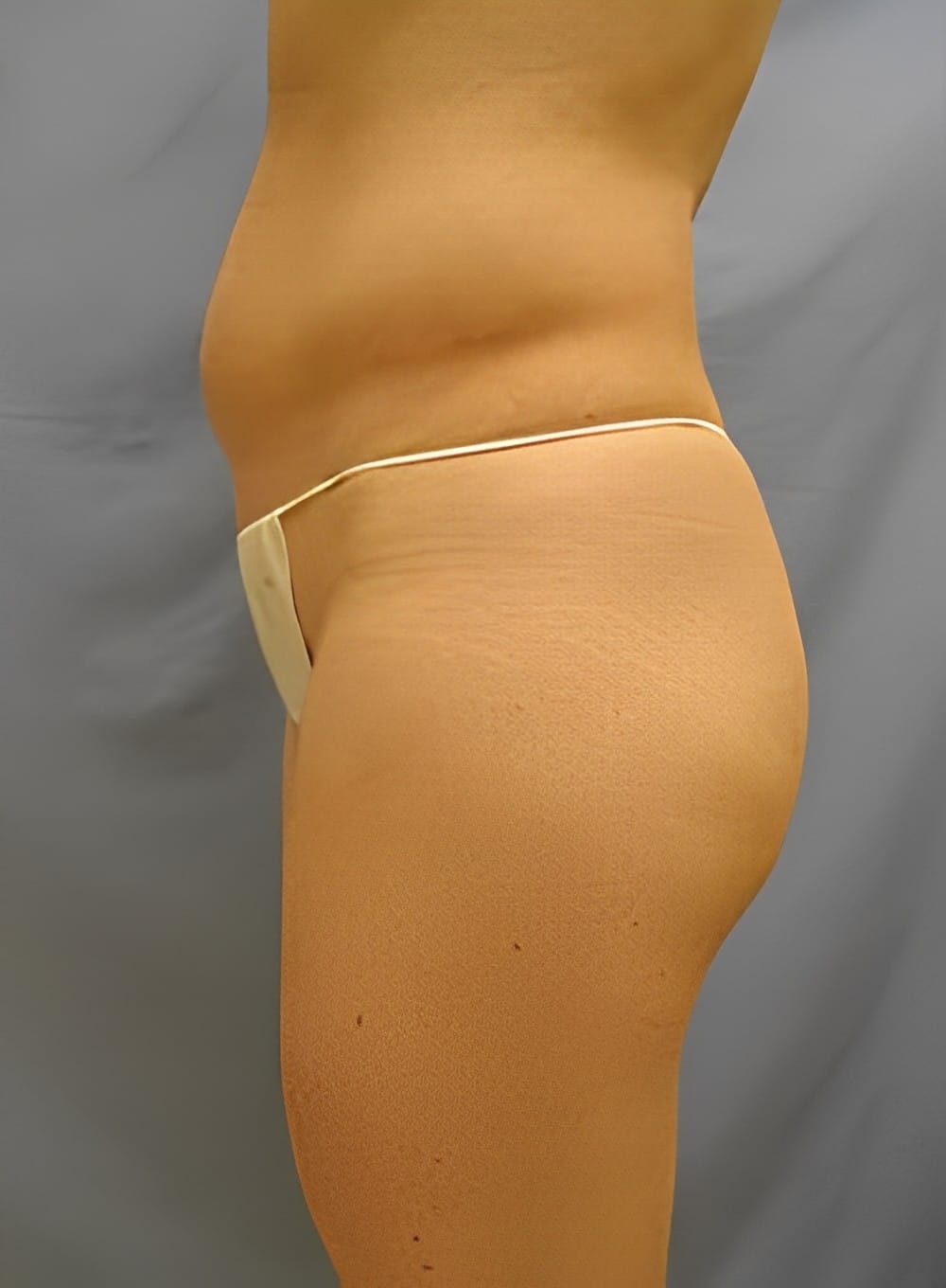 Before Image: Liposuction Abdomen-Dr. Kenrick Spence - left-side