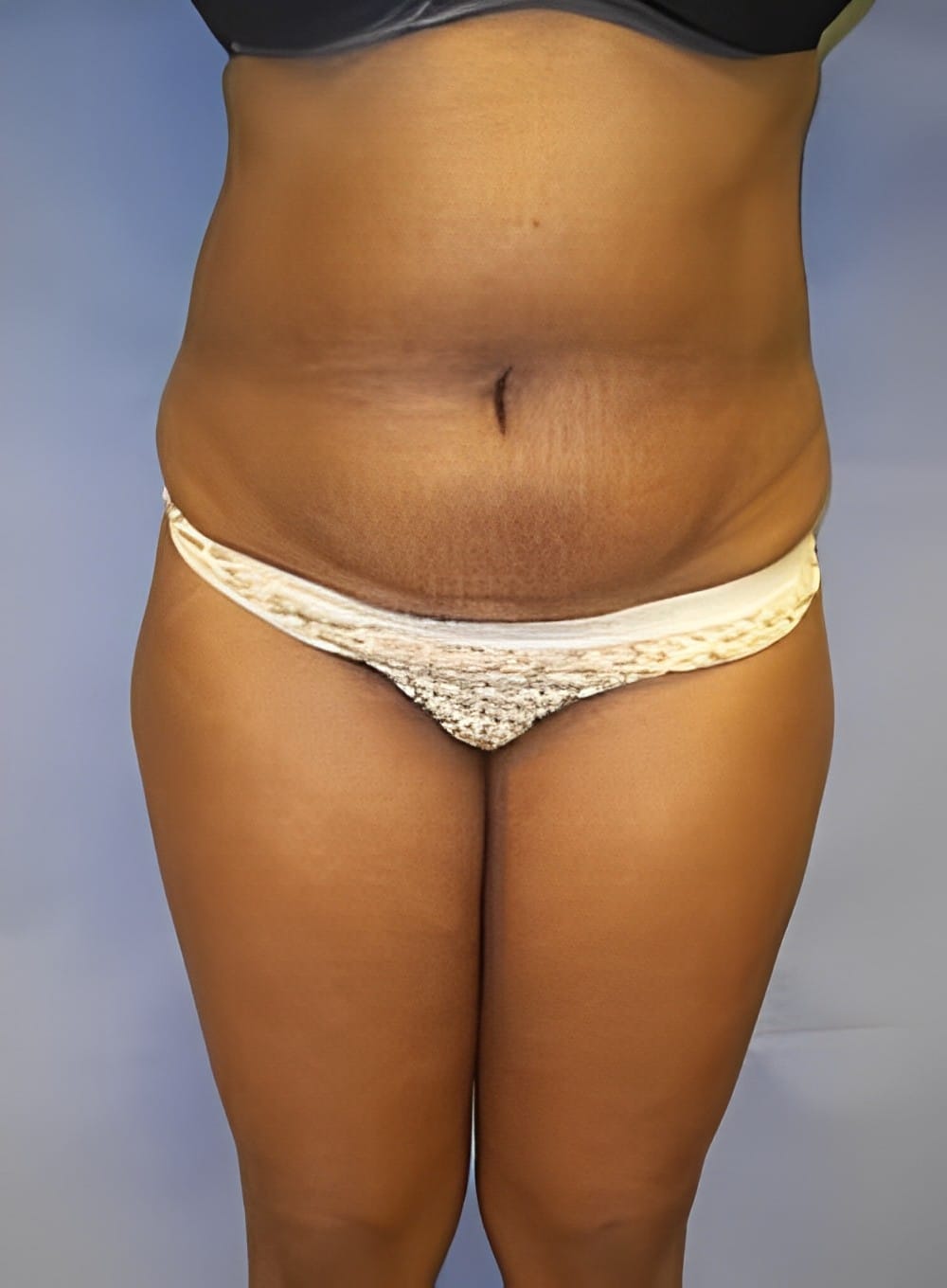 Before Image: Liposuction Abdomen-Dr. Kenrick Spence - front
