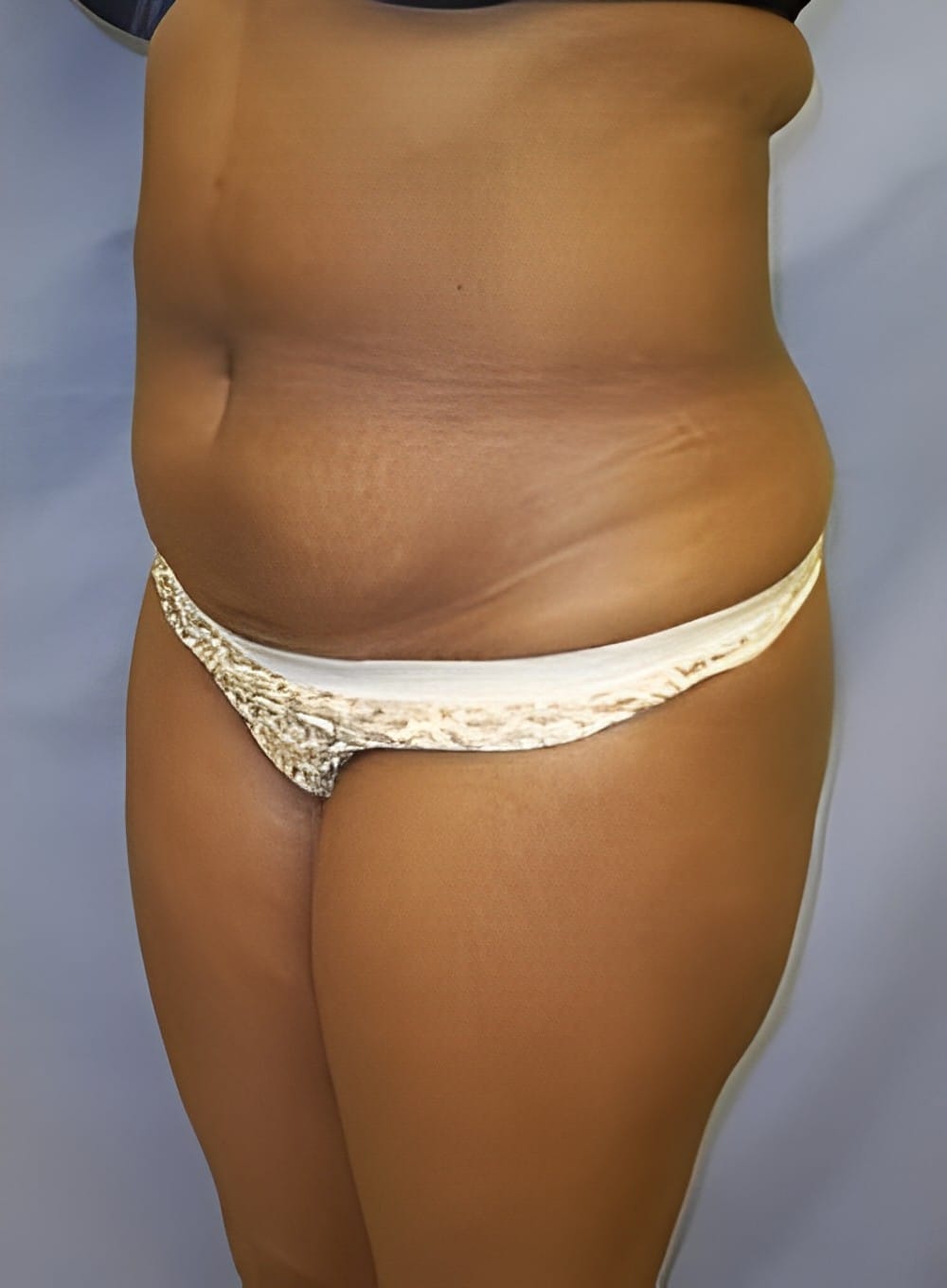 Before Image: Liposuction Abdomen-Dr. Kenrick Spence - left-front-oblique