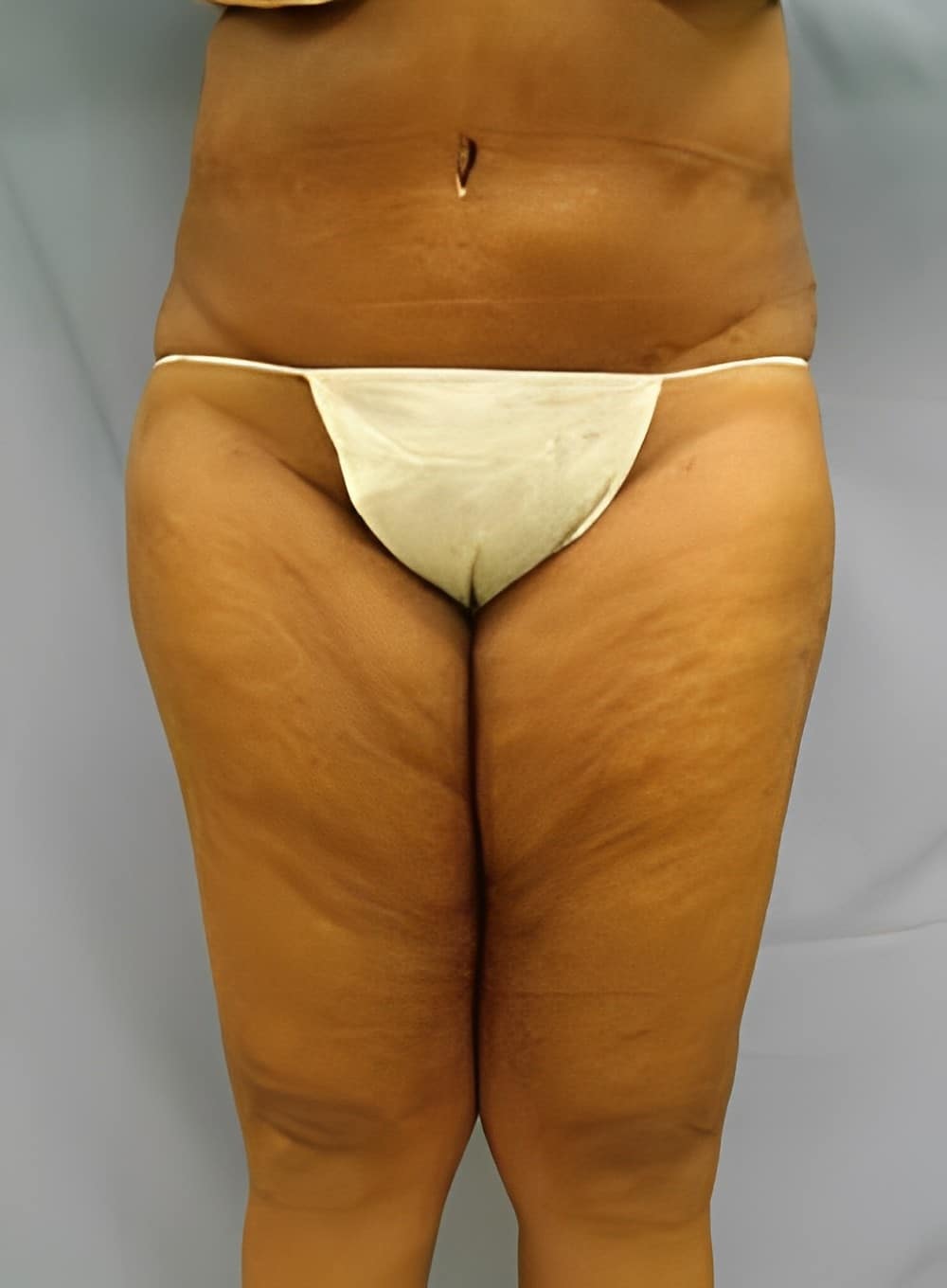 After Image: Liposuction Abdomen-Dr. Kenrick Spence - front