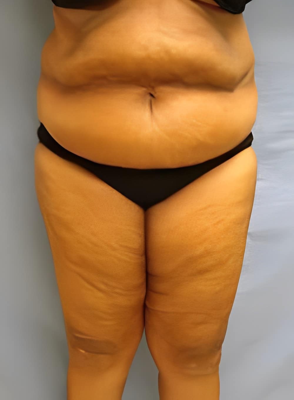 Before Image: Liposuction Abdomen-Dr. Kenrick Spence - front