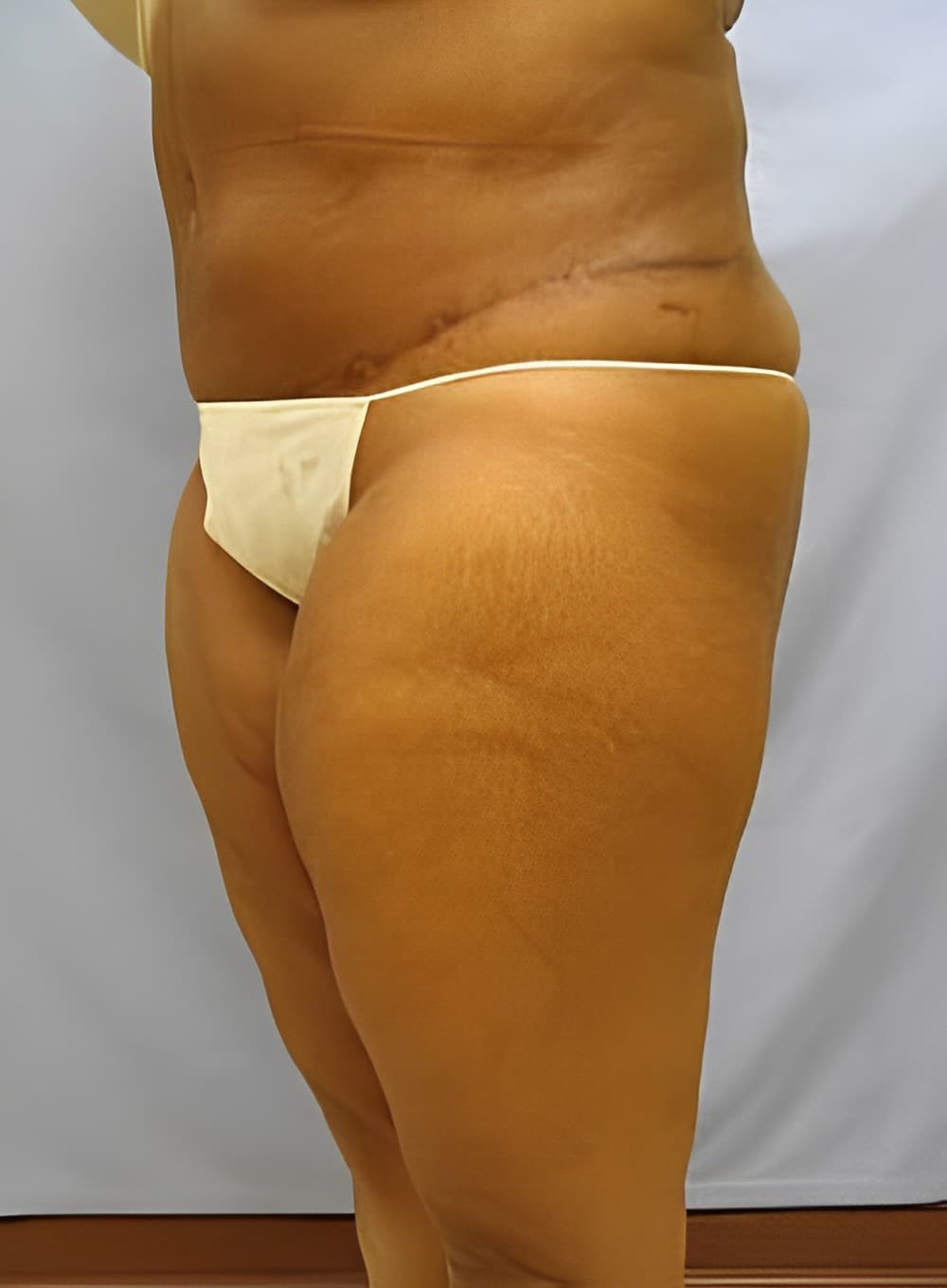 After Image: Liposuction Abdomen-Dr. Kenrick Spence - left-front-oblique