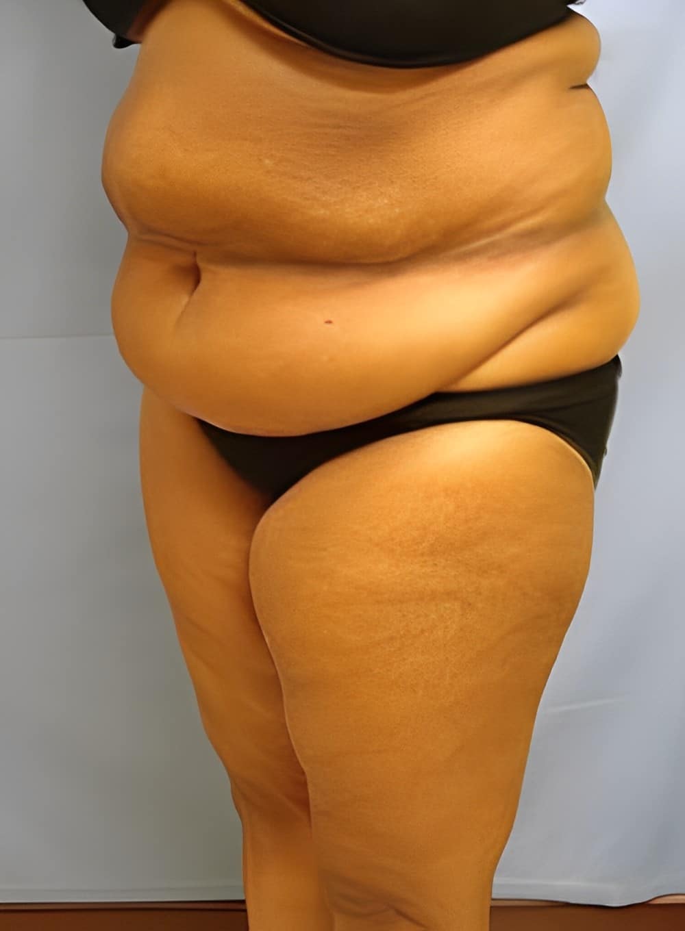 Before Image: Liposuction Abdomen-Dr. Kenrick Spence - left-front-oblique