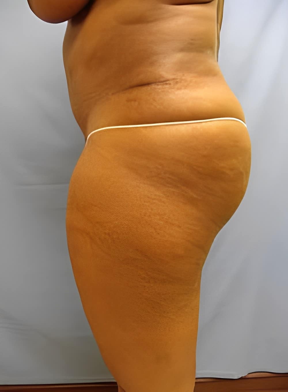 After Image: Liposuction Abdomen-Dr. Kenrick Spence - left-side