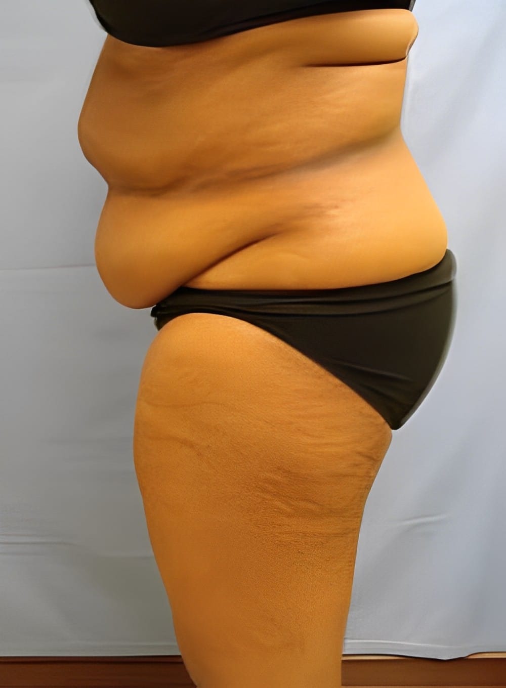 Before Image: Liposuction Abdomen-Dr. Kenrick Spence - left-side