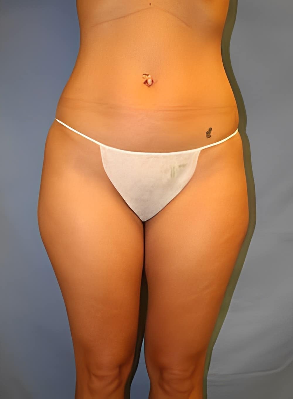 Before Image: Liposuction Back-Dr. Kenrick Spence - front