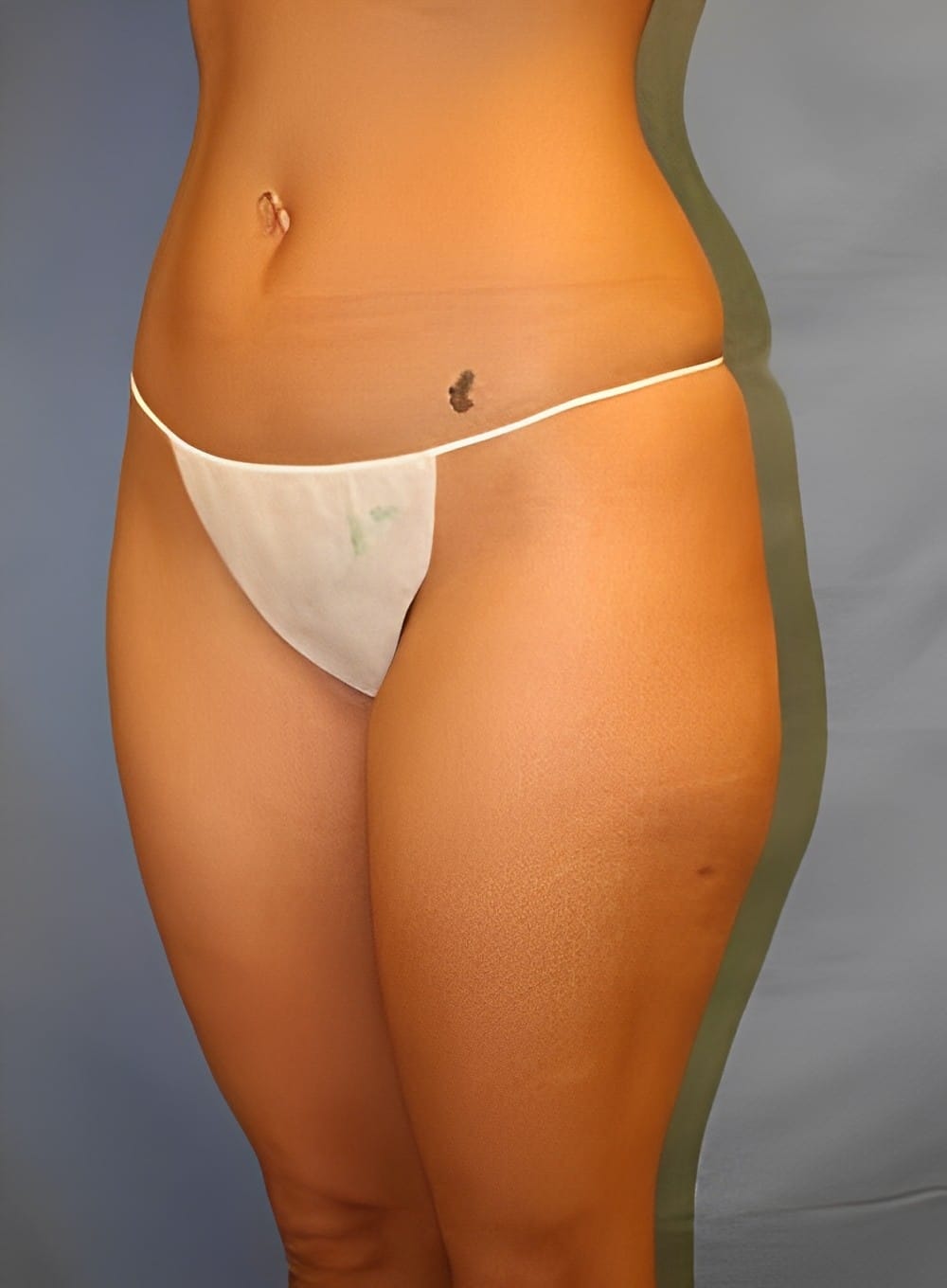 Before Image: Liposuction Back-Dr. Kenrick Spence - left-front-oblique