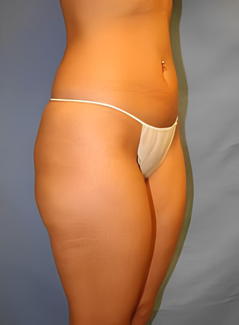 Before Image: Liposuction Back-Dr. Kenrick Spence - right-front-oblique