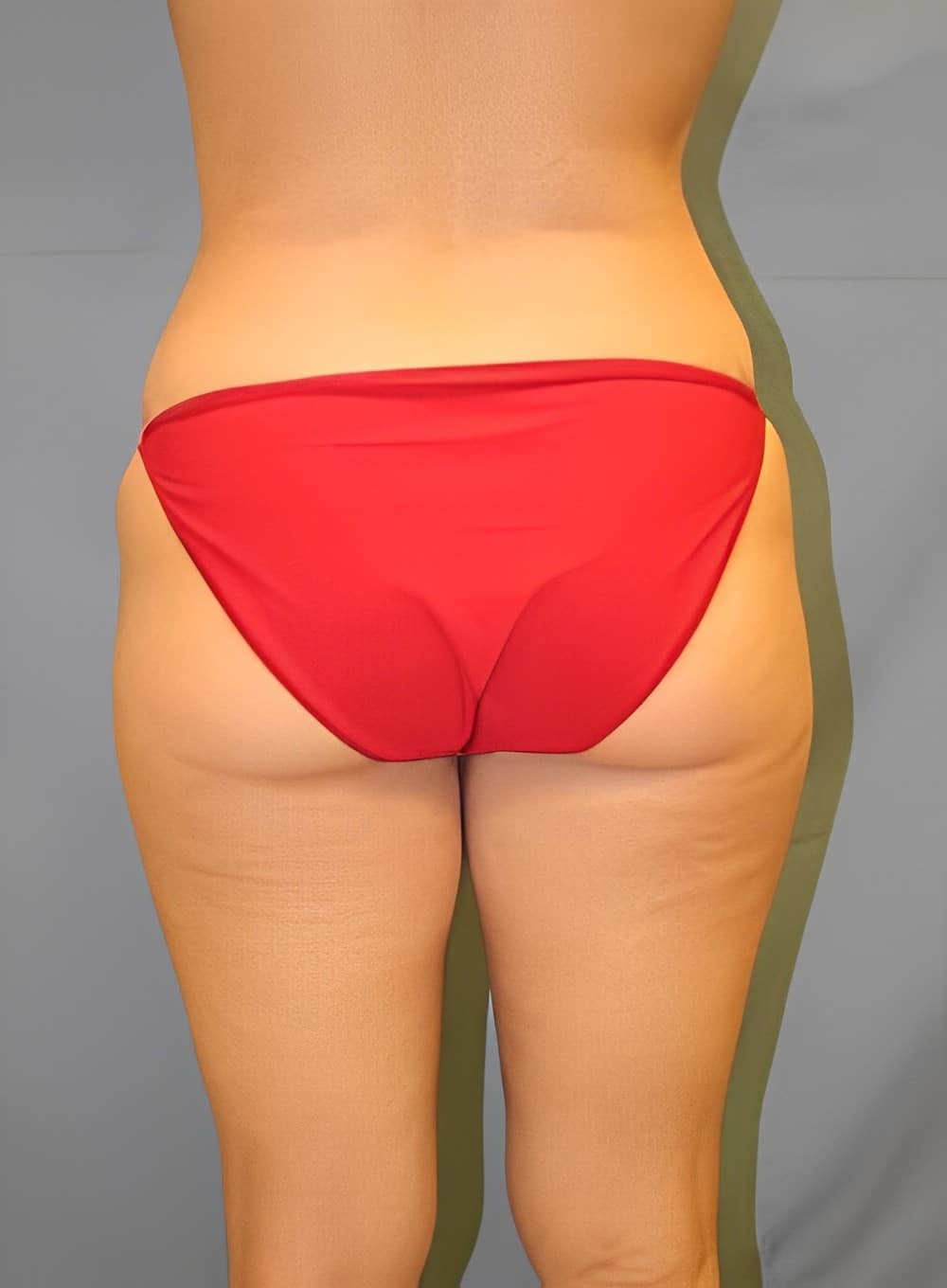 Before Image: Liposuction Back-Dr. Kenrick Spence - back