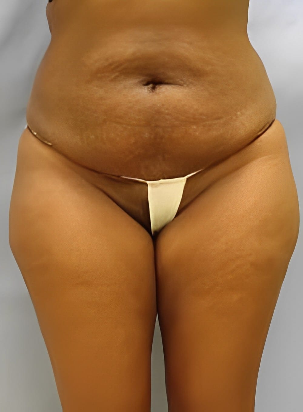 Before Image: Liposuction Back-Dr. Kenrick Spence - front