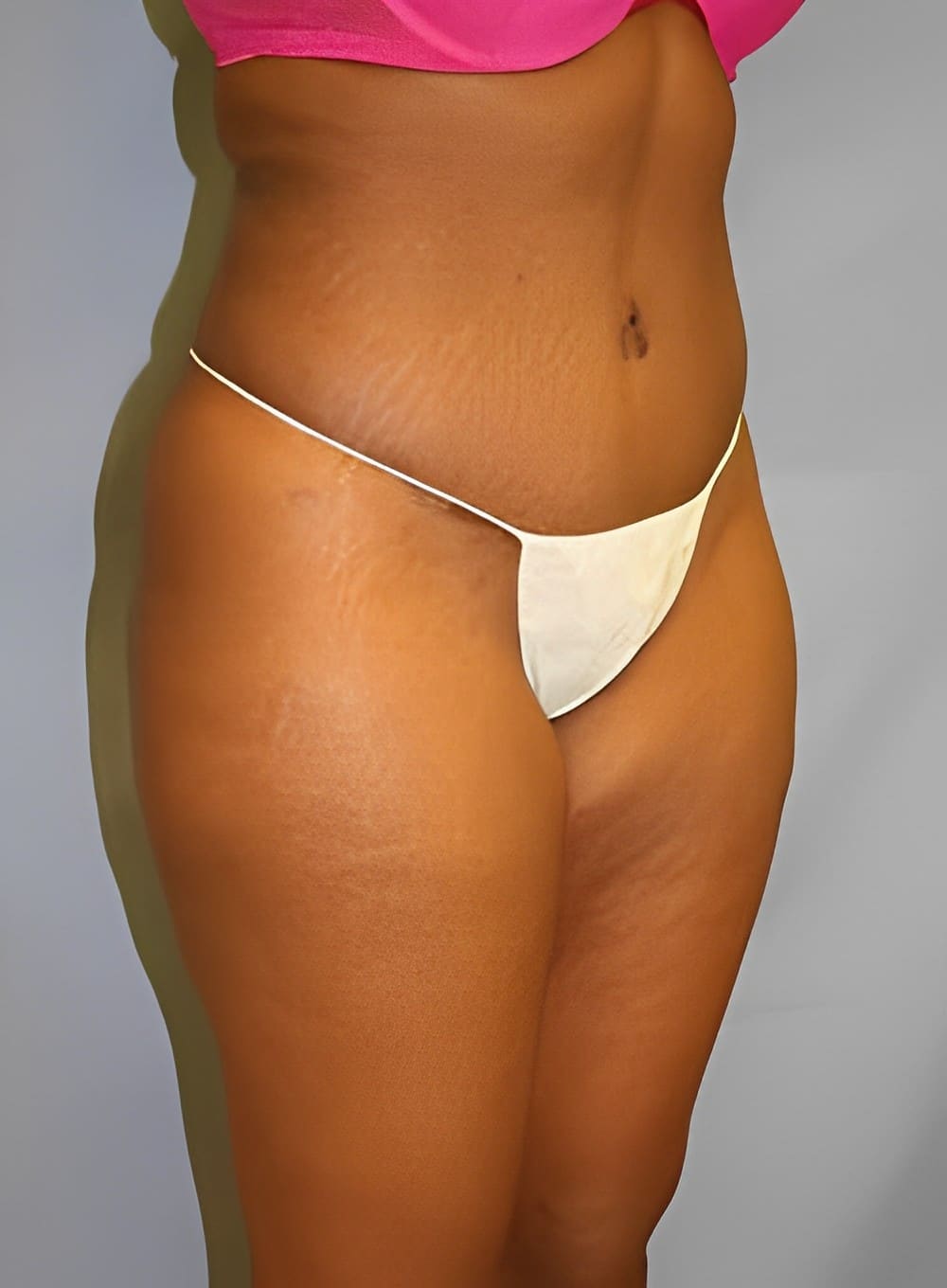 After Image: Liposuction Back-Dr. Kenrick Spence - right-front-oblique