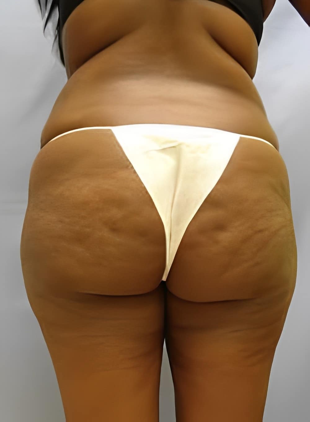 Before Image: Liposuction Back-Dr. Kenrick Spence - back