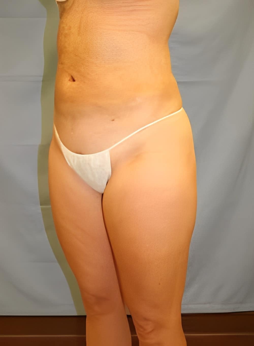 After Image: Liposuction Back-Dr. Kenrick Spence - left-front-oblique