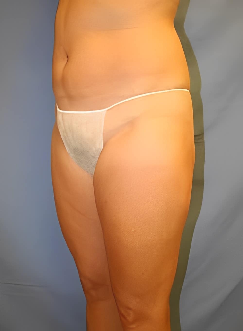 Before Image: Liposuction Back-Dr. Kenrick Spence - left-front-oblique