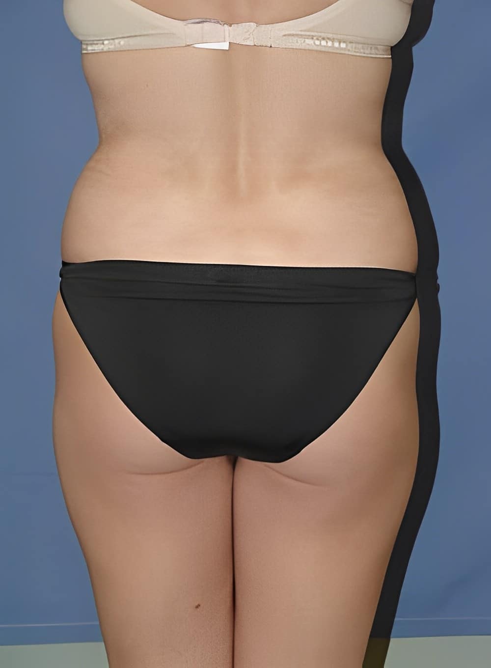 Before Image: Liposuction Back-Dr. Kenrick Spence - back